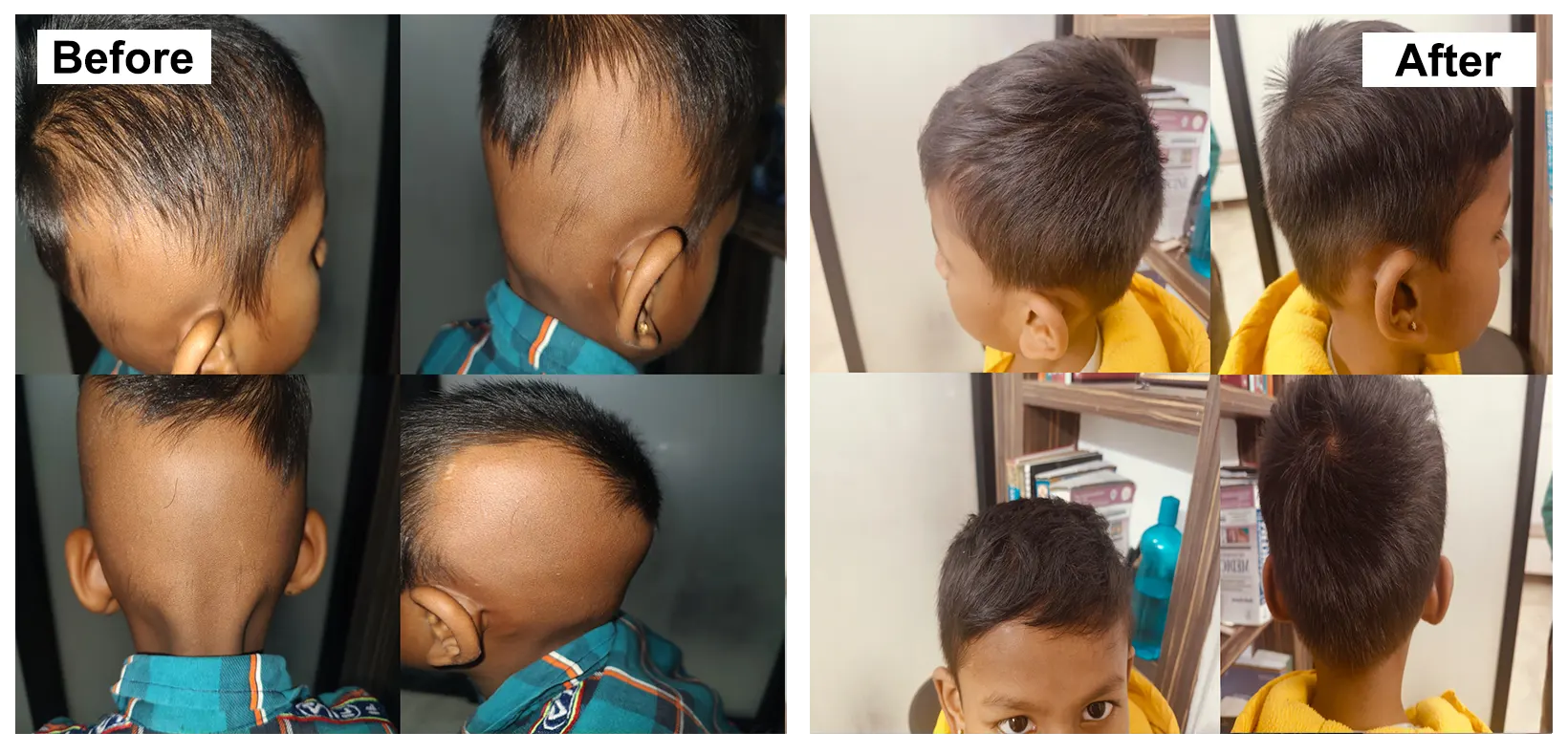 ALOPECIA AREATA 2