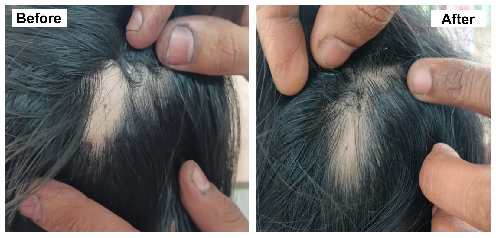 ALOPECIA AREATA