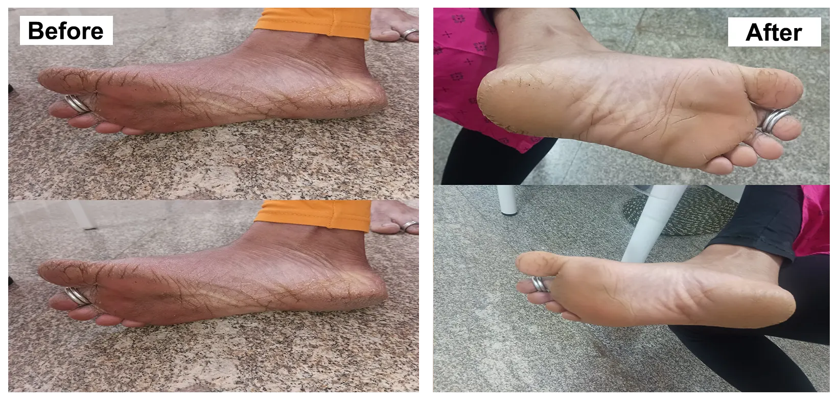 DERMATITIS TREATMENT WITH HOMEOPATHY