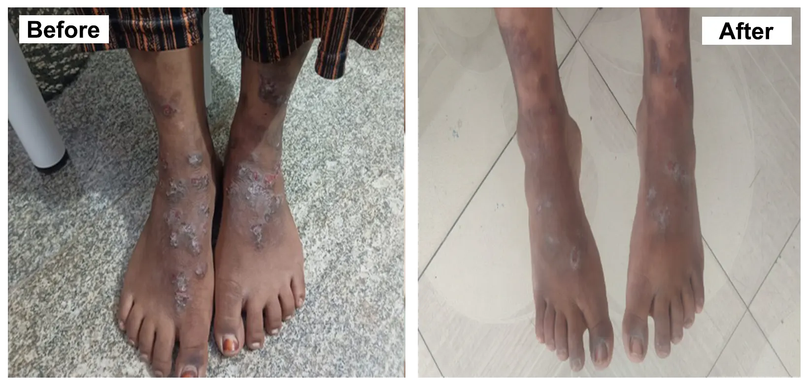 ECZEMA dematitis treatment with Homeopathy