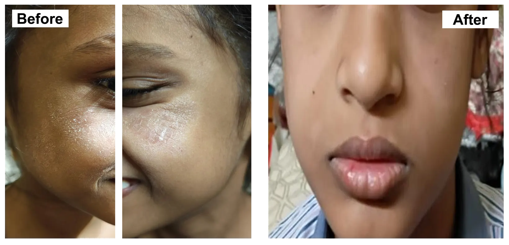 PEDIATRIC ATOPIC DERMATITIS