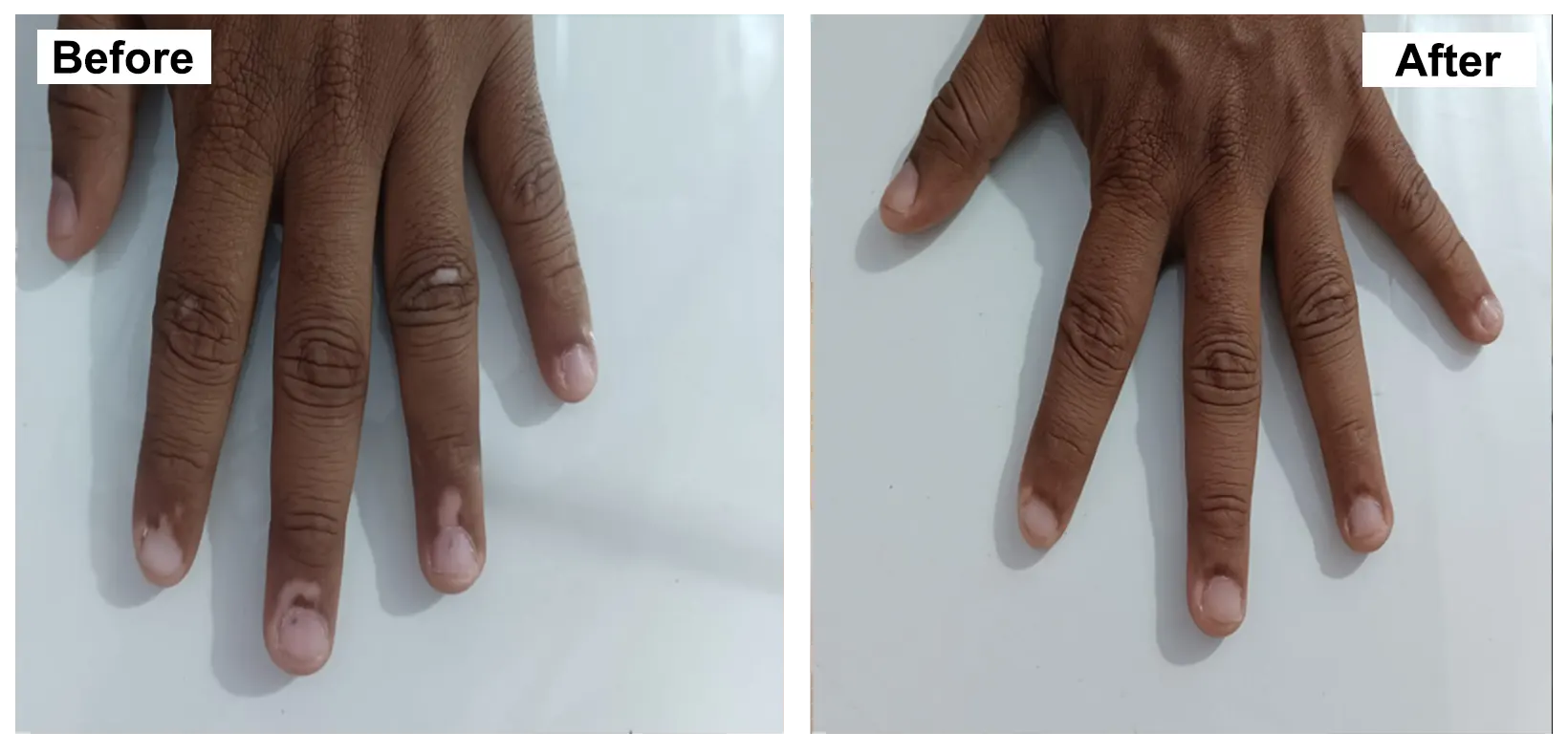 VITILIGO TREATMENT WITH HOMEOPATHY