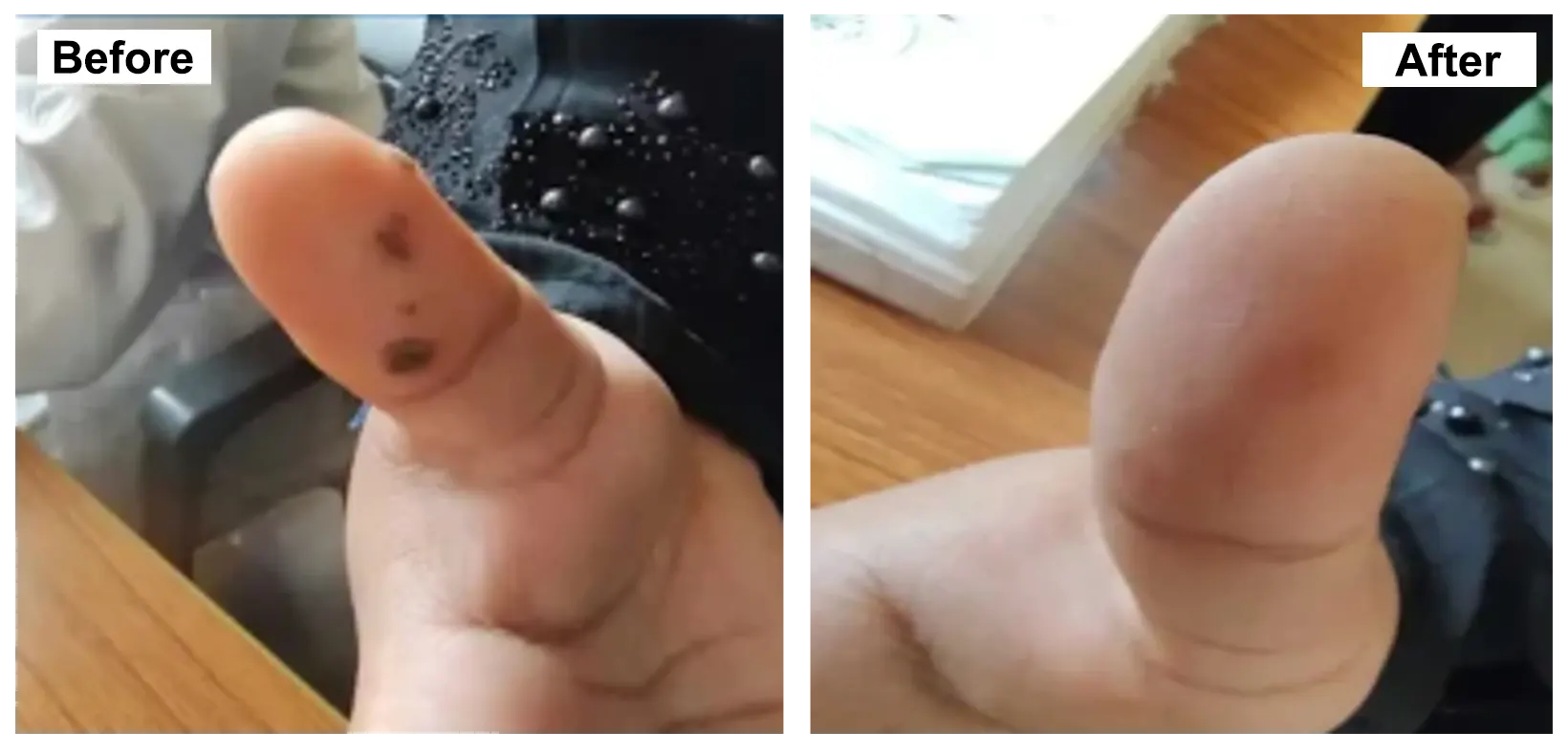 WARTS treatment with Homeopathy
