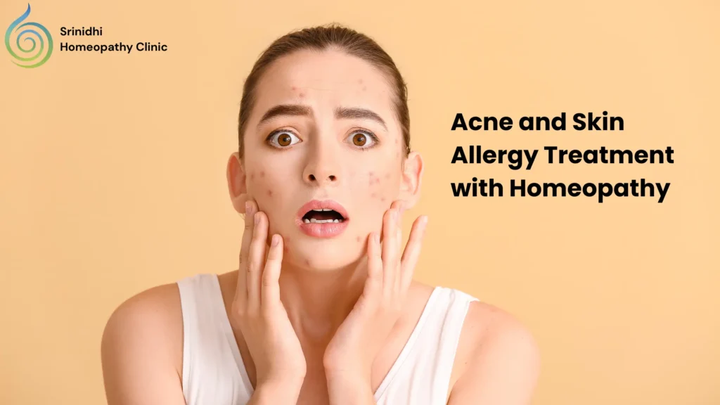 Acne and Skin Allergy Treatment with Homeopathy